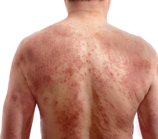 Controlling Eczema by Moisturizing